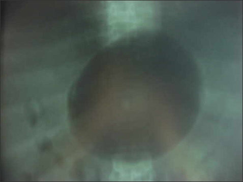 Balon Intra Gastrico El Salvador