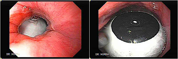 Balon Intra Gastrico El Salvador