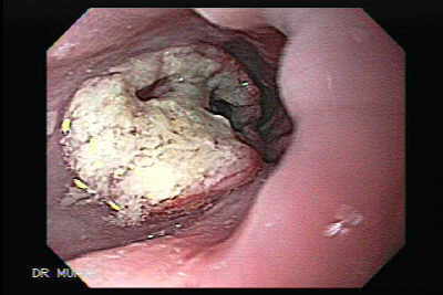 Endoscopia Sonsonate