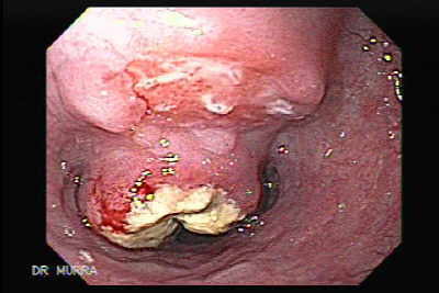 Endoscopia Sonsonate